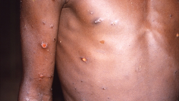 What does monkeypox look like? What to know as Toronto finds new cases