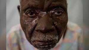 Christophe Chavilinga, 90, suffering from mpox, waits for treatment at a clinic in Munigi, eastern Congo, Friday, Aug. 16, 2024. (AP Photo/Moses Sawasawa)