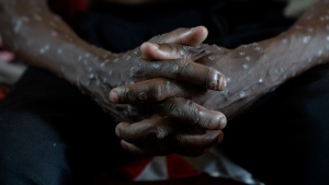 A man suffering from mpox waits for treatment at a hospital in South Kivu, Congo on Sept. 4, 2024. (Moses Sawasawa / AP Photo)