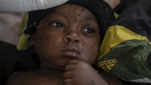 Emile Miango, 2, who has mpox, lies in the hospital, on Wednesday, Sept. 4, 2024, in Kamituga, South Kivu province, which is the epicentre of the world's latest outbreak of the disease in eastern Congo. (AP Photo/Moses Sawasawa)